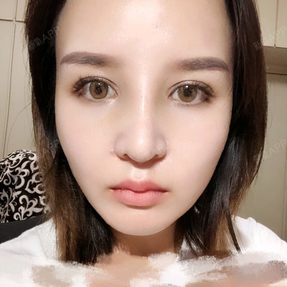 杭州耳软骨复合隆鼻好不好_效果图_春去夏来耳软骨复合隆鼻术后第6天