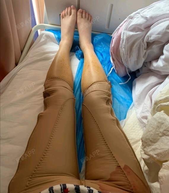 终于鼓起勇气跟朋友来做大腿吸脂了大腿吸脂第一天右腿_圈子-新氧美容