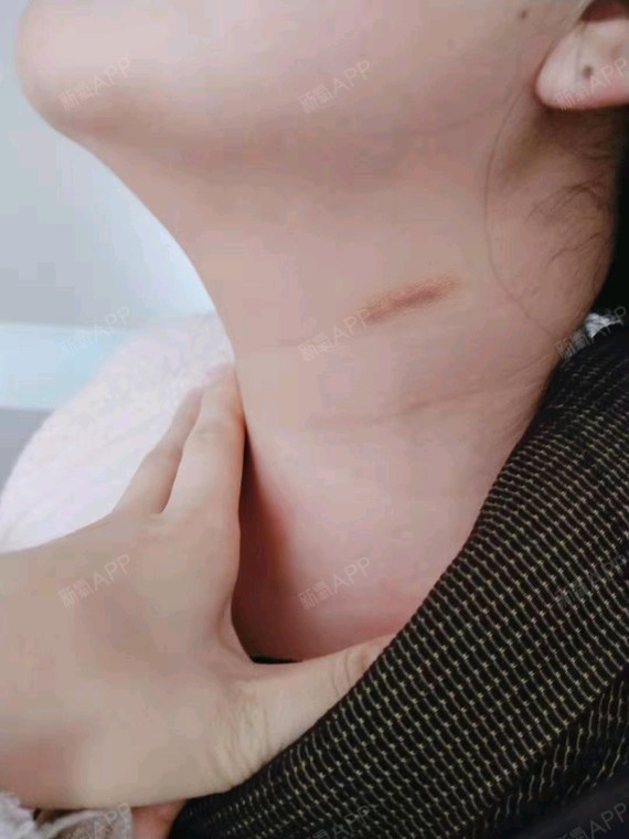 乳房棒棒糖切口疤痕图片
