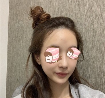 我的鼻子正面看上去整个鼻部缺乏立体感,毕竟鼻子是个_圈子-新氧美容