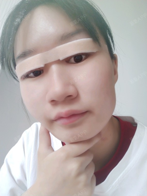 双眼皮术后第一天,初眼有点眼窝凹陷,轻微的内眦赘皮_圈子-新氧美容