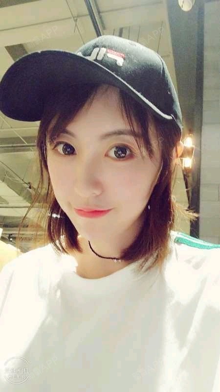 【星妍医美 玻尿酸全脸填充】注射23天了,已经恢复_圈子-新氧美容整形
