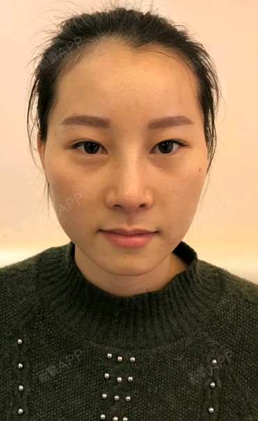 佛山玻尿酸丰卧蚕好不好_效果图_氧气fog4m玻尿酸丰卧蚕术后第0天