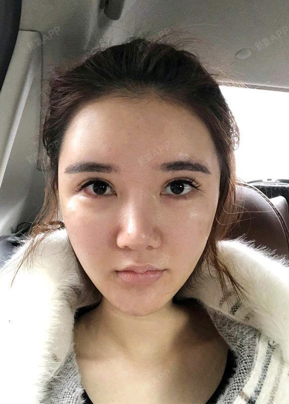 【线雕第7天】线雕的恢复除了自身体质是一方面,医生_圈子-新氧美容