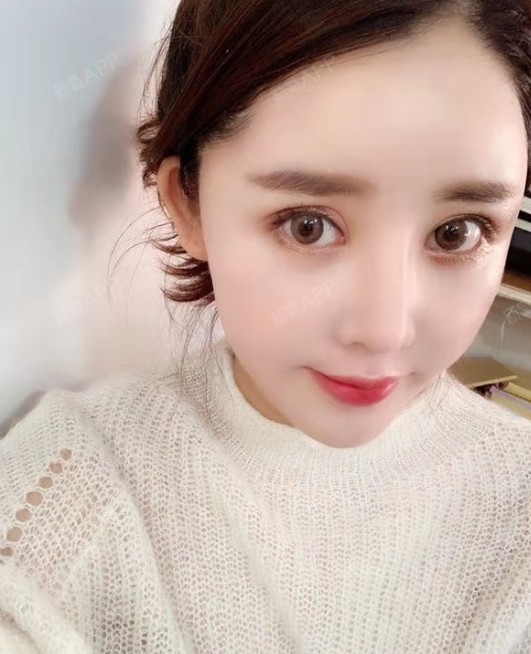 自体脂肪填充卧蚕