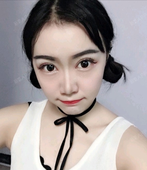 双眼皮真的是很不错,形状弧度都很好,也很自然!