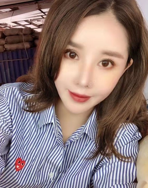 自体脂肪填充卧蚕