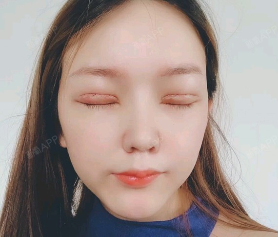 以前我是天生的肿泡眼,之前就做过埋线,不过现在时间_圈子-新氧美容