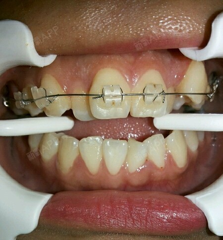 我的口腔情况是这样的,医生检查后说牙性深覆盖,侧面_圈子-新氧美容