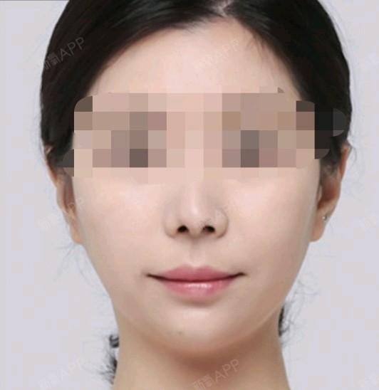 首页 此页面仅支持预览 Avatar 氧气kcm0y 2篇日记 商品 查看 M唇手术 唇珠成型 M唇 微笑唇 花瓣唇 Pp唇 厚唇改薄 嘴角上扬 唇修复术 性感美唇 胡春雷 上海馥兰朵医疗美容 品牌连锁 已售17 M唇手术项目术后第312天 之前我的嘴唇特别厚 唇形也不好看