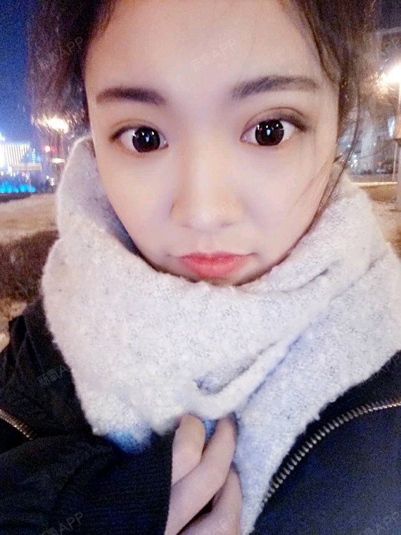 【星妍医美  双眼皮】术后已经一周了,开心的不得了,已经不是