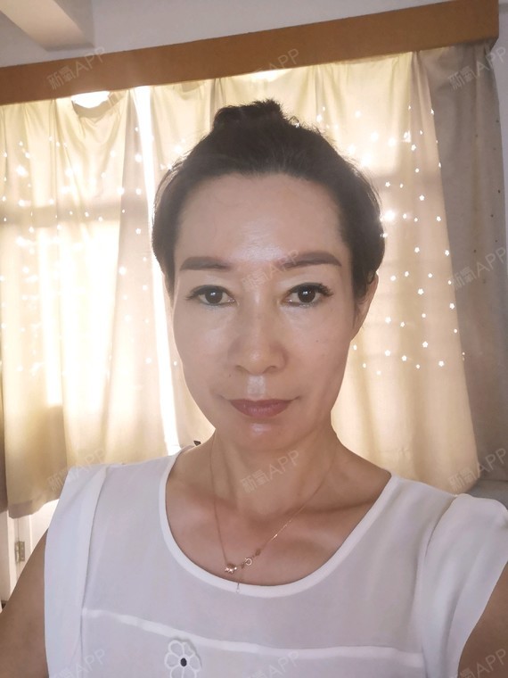 【星妍醫美 去眼袋】做完眼袋手術已經3個月了,做完_圈子-新氧美容