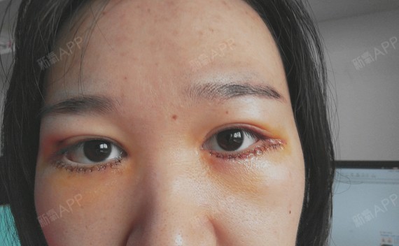 外切祛眼袋恢复期图片图片