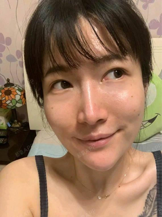 沈阳m唇手术好不好_效果图_异能量酷girlsm唇手术术后第7天_新氧美容