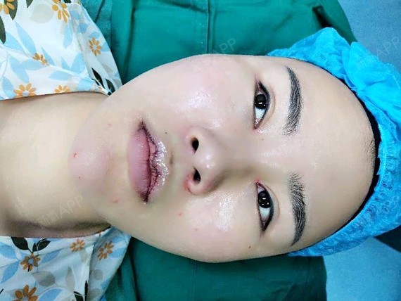 【元素美学m唇】我的唇形是属于丰满的那种,上下唇都_圈子-新氧美容