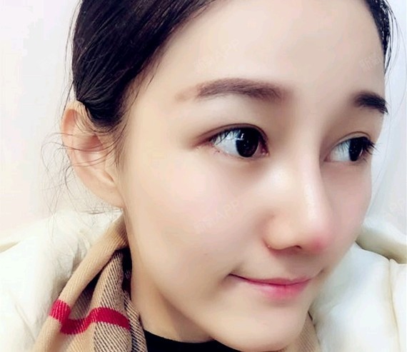 耳软骨复合隆鼻好不好_效果图_诺式美妮耳软骨复合隆鼻术后第8天_新氧