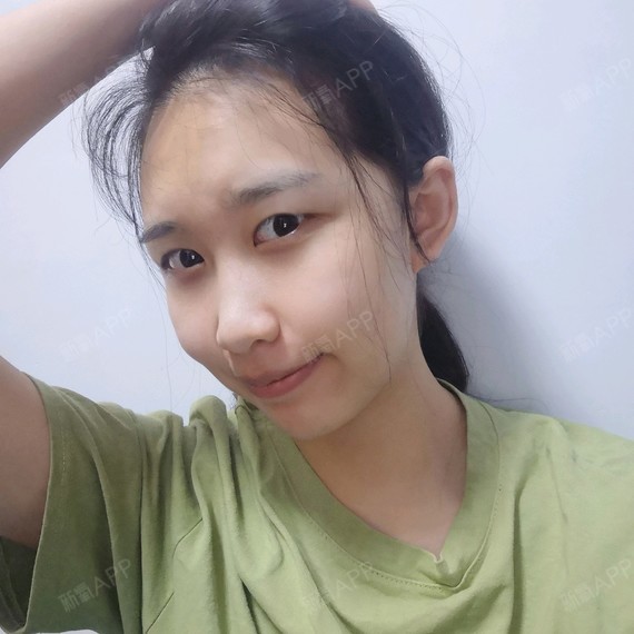 【星妍医美 双眼皮】哈喽,大家好!之前我的眼睛是_圈子-新氧美容整形