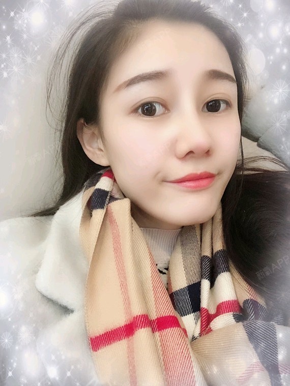 耳软骨复合隆鼻好不好_效果图_诺式美妮耳软骨复合隆鼻术后第65天