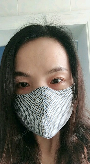 时间好快,今天是手术后的第8天.拆线了,现在真的没_圈子-新氧美容整形