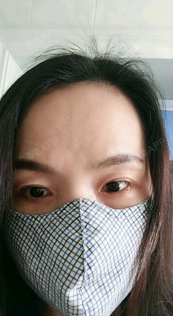 时间好快,今天是手术后的第8天.拆线了,现在真的没_圈子-新氧美容整形