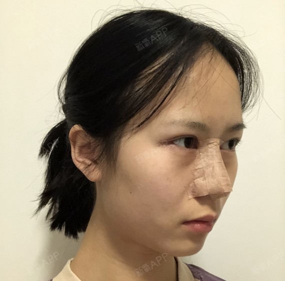 鼻子隆鼻手术图片_鼻子隆鼻后多久恢复正常_隆鼻鼻子