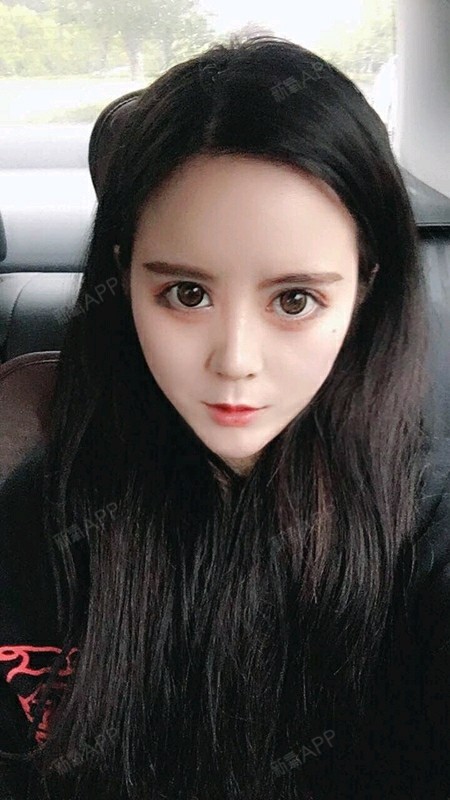 自体脂肪填充卧蚕