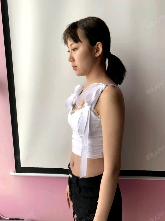 妊娠纹整形美容（妊娠纹的美容治疗） 妊娠纹整形美容（妊娠纹的美容治疗）《妊娠纹整形价格》 整形美容