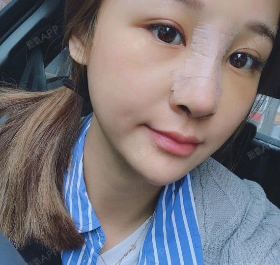 大连膨体隆鼻好不好_效果图_氧气lhxt3膨体隆鼻术后第6天_新氧美容