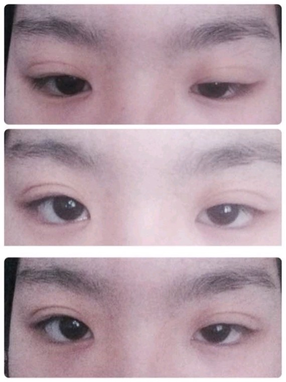 畸形,多为双侧,有时为单侧,可为常染色体显性或隐性遗传,可以通过上