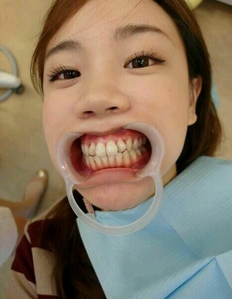 女生有一口白皙的牙齿实在太重要了呀