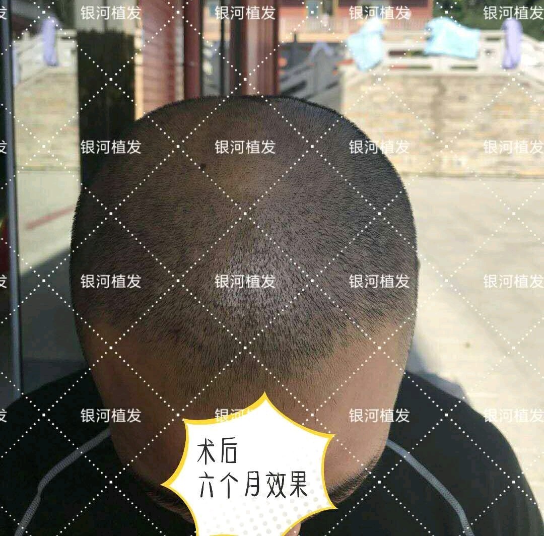 少林寺俗家弟子植发术后六个月效果,种植区域头发密度杠杠的[强]