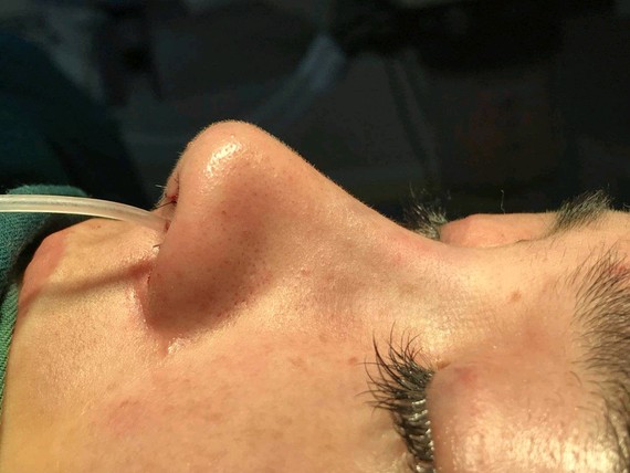 好痛啊好痛啊～我做的肋软骨加膨体的鼻部多项隆鼻,没有_圈子-新氧