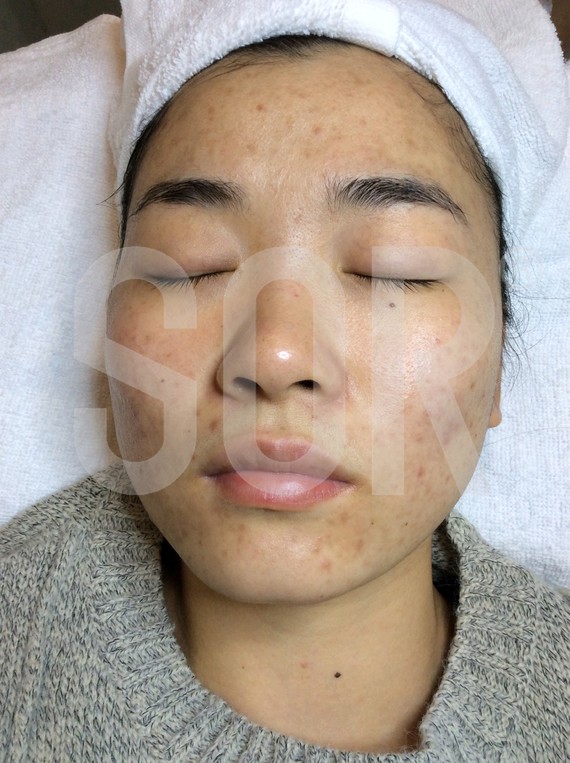 皮肤 | 术后当自强 | 昆明同城 | 护肤 | 清洁祛痘 | 清痘针