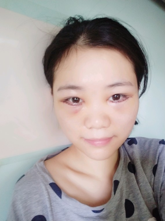 手术就直接回家了,因为做嘟嘟美眼术需要做外路去眼袋,然后再做卧蚕