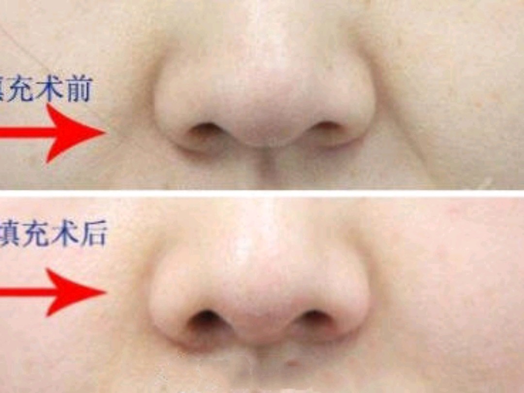 一箭双雕的鼻畸形修复：鼻基底填充 - 知乎