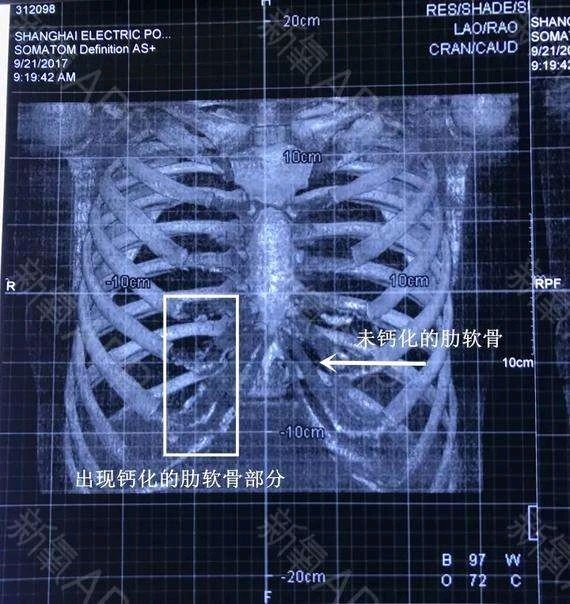 肋骨钙化了还能用吗