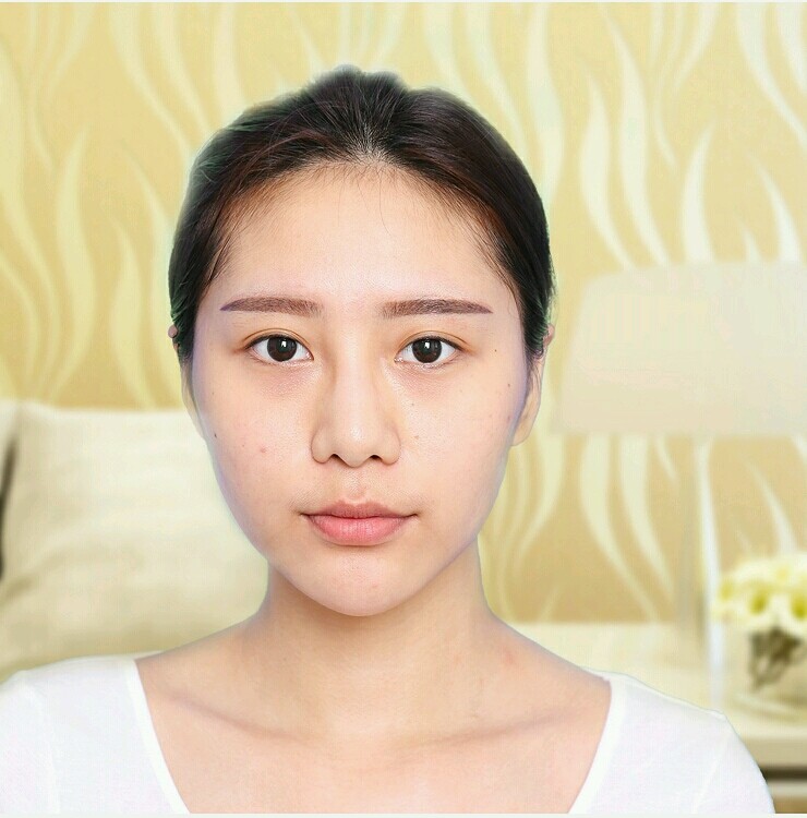 隆鼻5年,我需要换假体吗?现今隆鼻手术_圈子-