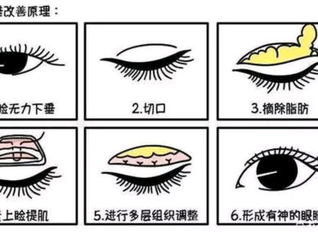 术后眼睑闭合不全是什么原因