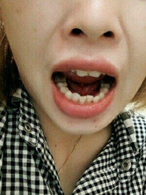 [:32]矫牙完保持器要戴多久?[:92][:92][:76]随着