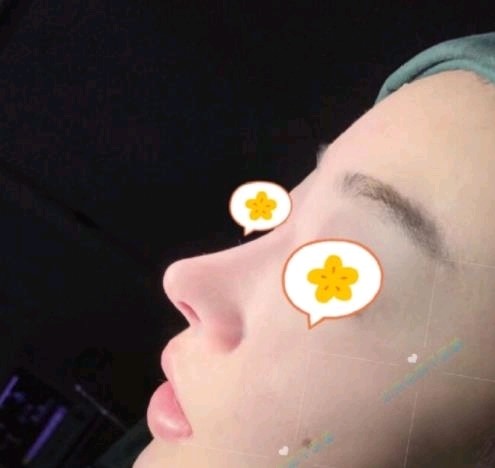 只是将鼻梁垫高,鼻尖不会改变.