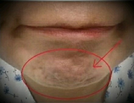 放松颏肌注射可以减少下巴紧绷感,减少核桃纹,视觉上有延长下巴的