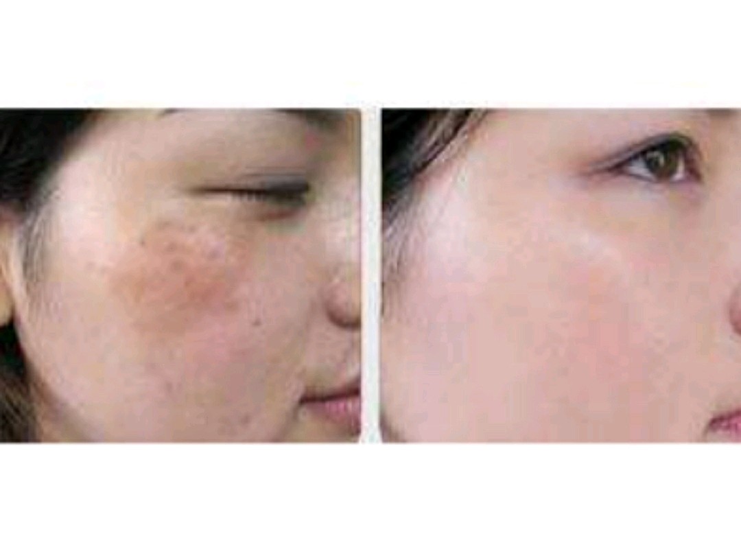 光子祛斑和激光祛斑有什么不同?