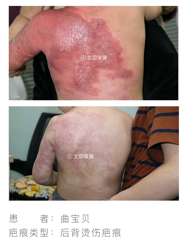 【小孩烫伤疤痕增生病例分享】