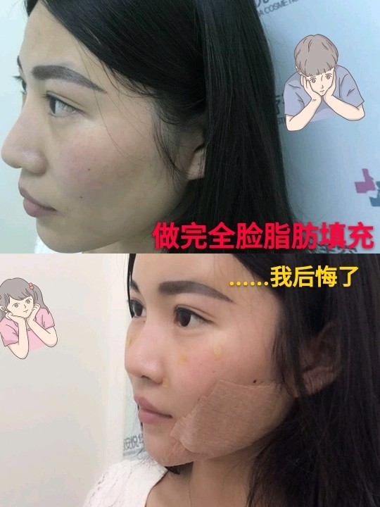 我做了脂肪填充全脸的手术 非常后悔没有早点做脂肪填 圈子 新氧美容整形