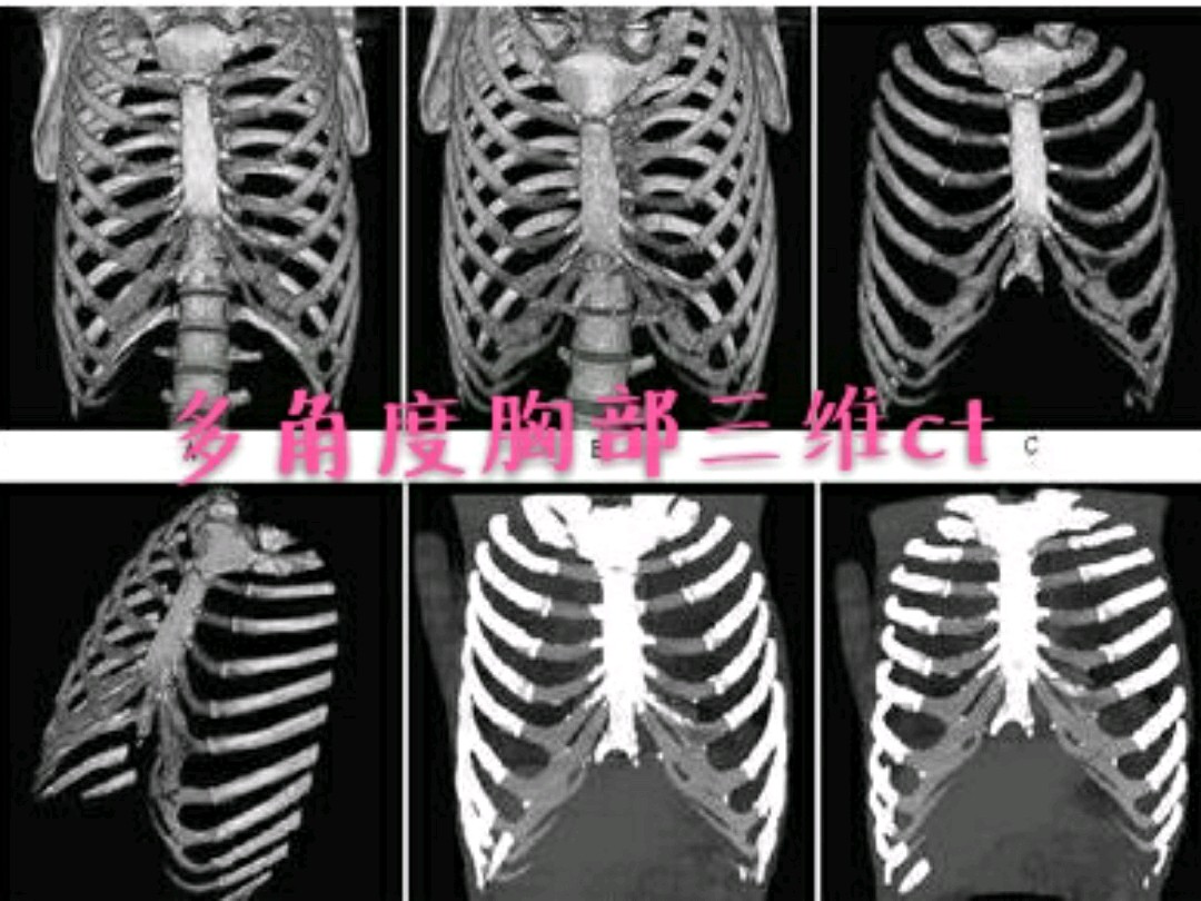 腰肋三角疝ct图像图片