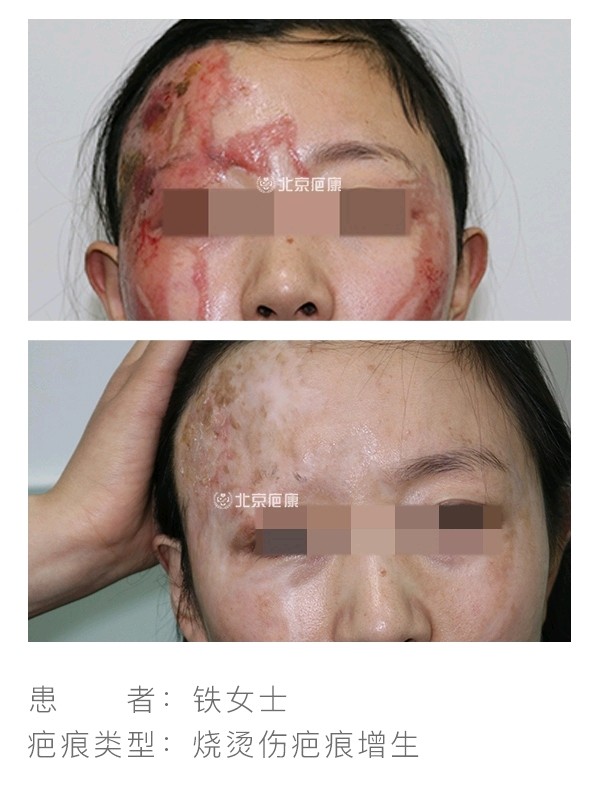 【烧伤疤痕增生病例分享】铁女士不幸被硫酸烧伤,及时_圈子-新氧美容
