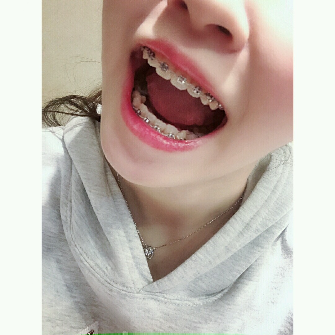 大龄矫正牙,我的牙齿会提前掉吗?