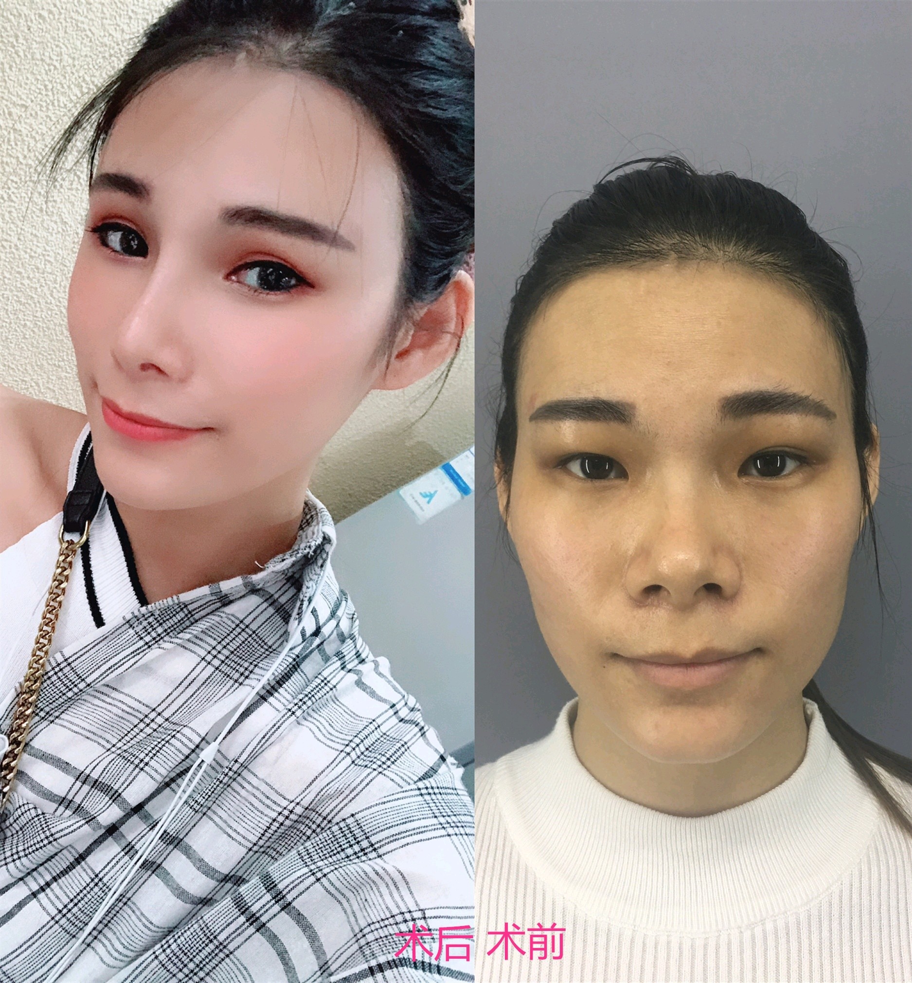 改善我的蒜头鼻~ 我的鼻子属于那种俗_圈子-新氧美容整形