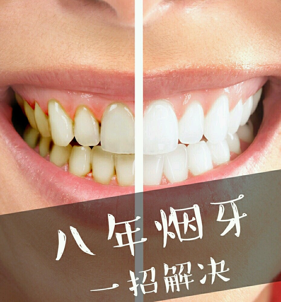 牙齿着色一般分为 修复治疗和漂白治疗两种治疗手段.
