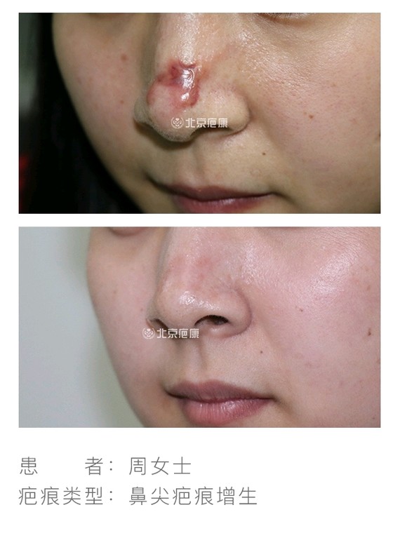 鼻尖受伤创面愈合后出现疤痕增生怎么办